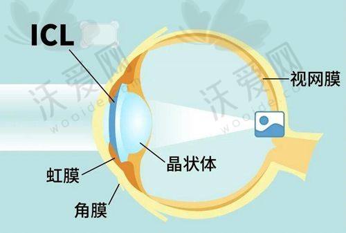 杭州飞秒秒眼科医院全飞秒价格14800元起，微创无痛恢复快还低干眼率别错过！