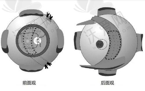 2025西安四院眼科预约流程&报销比例