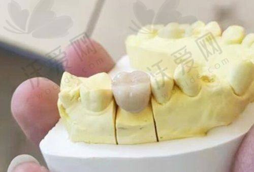 太原皓雅口腔全瓷牙贴面美白的作用和成效