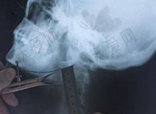洛阳孔繁荣医美经典超声炮+下颌缘项目有哪些技术优势？