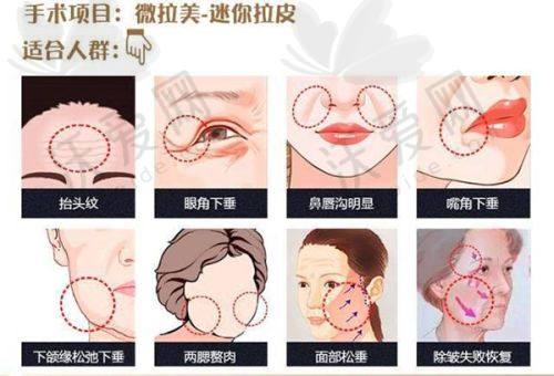 南宁芭芘丽整形硅胶垫下巴的作用与成效