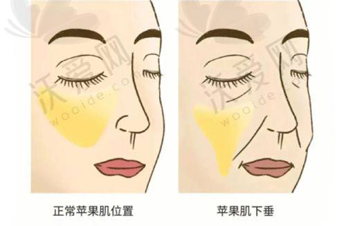 洛阳孔繁荣医美嗨体熊猫+弗缦胶原蛋白眼周年轻化套餐的项目优势