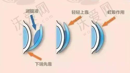 北京美尔目眼科医院上班时间避坑指南