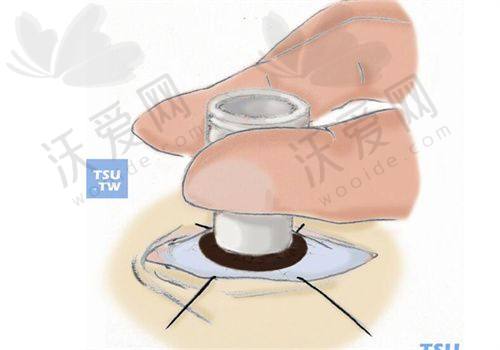 重庆华厦眼科熊金巧医生LASEK近视眼手术技术好在哪？