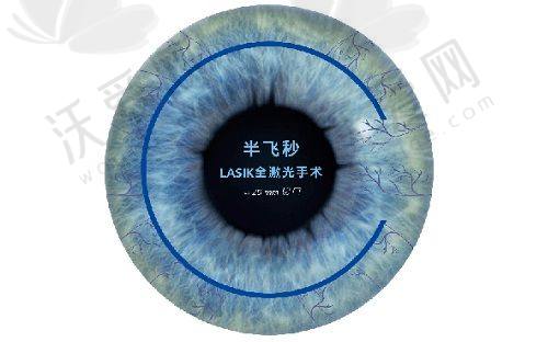 重庆华厦眼科蔡锡安全飞秒近视手术13800元起，切口小恢复快轻松告别近视烦恼