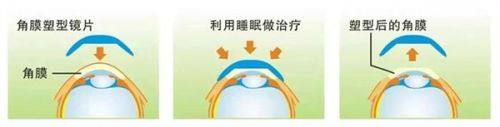 深圳佰视佳眼科医院陶莉医生半飞秒近视手术9800元起，个性化方案助你快速摘镜