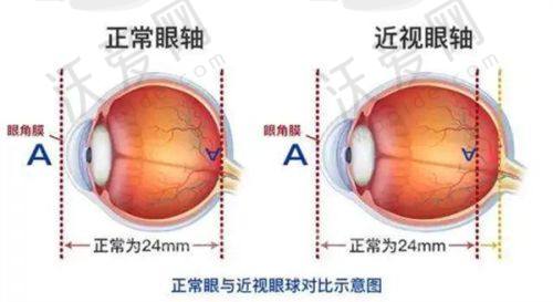 患者选择深圳普瑞眼科刘泉院长SMILEpro全飞秒近视手术能获得怎样的服务？