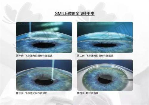 深圳普瑞眼科OPT脉冲光干眼治疗有哪些优势呢？