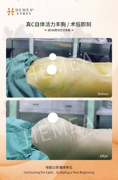深圳非凡医疗美容医院林茂辉医生技术好不好？