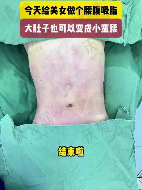 南宁芭芘丽整形严飞腰部手术吸脂3680元起，精准吸脂创伤小速拥小蛮腰