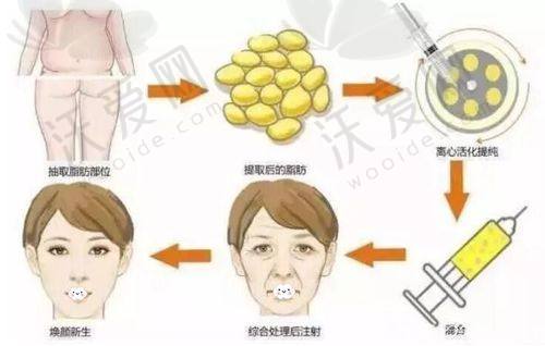哈尔滨羽禅整形全方面部吸脂技术有哪些优势？