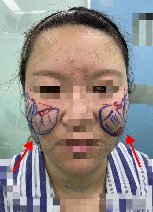 哈尔滨羽禅整形全方面部吸脂能带来什么成效？
