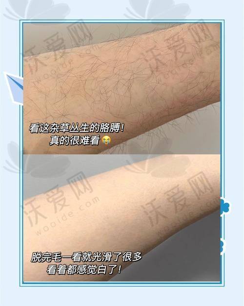 哈尔滨羽禅医疗美容手臂冰点脱毛依托新型设备有保护