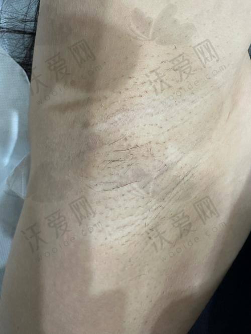 哈尔滨羽禅医疗美容手臂冰点脱毛技术精良成效好