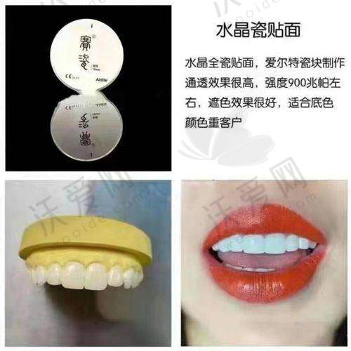南京美奥口腔医院E-max铸瓷贴面是什么产品？