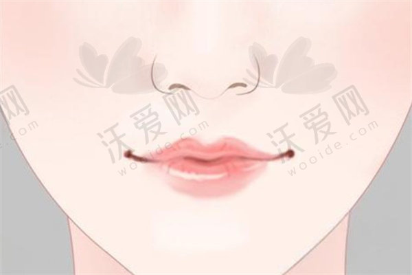 深圳福雅整形厚唇改薄原价3380元现2380元起！轻松提升整体的容貌和魅力