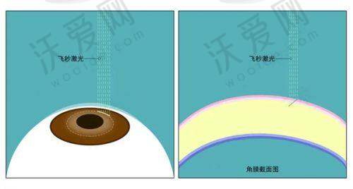深圳悦瞳眼科李静医生技术怎么样？