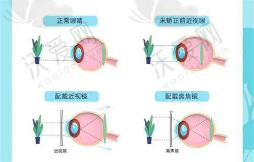 深圳悦瞳眼科医院陈韶红的精细化雕刻半飞秒技术有什么优势？