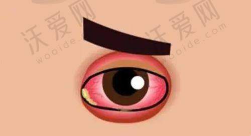 深圳悦瞳眼科医院OPT脉冲光干眼症理疗980元起，进口设备+个性方案还你水润双眸