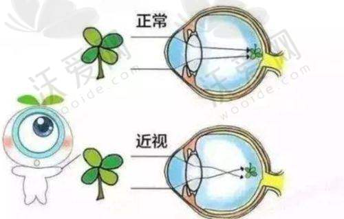 广州爱尔眼科干眼症熏蒸雾化理疗有哪些作用和成效呢？