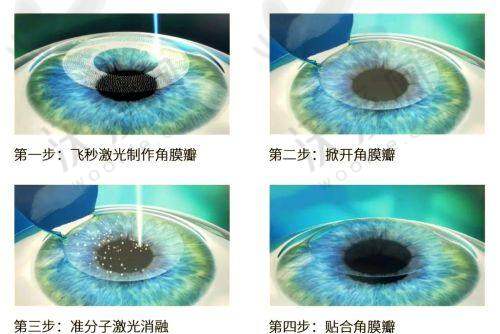 深圳悦瞳眼科陈星医生蔡司3.0+FX500半飞秒使用的是什么技术？