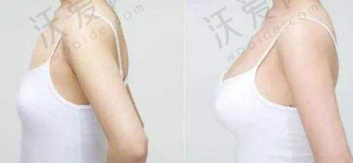 总结——广东广州美恩医疗美容整形医院郑志芳医生怎么样？