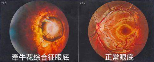 江西赣州普瑞眼科医院许小毛医生技术好不好？