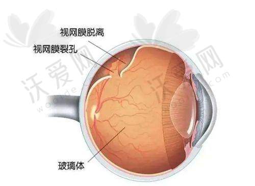 天津普瑞眼科医院白内障超声乳化，骨干医生团队保驾护航