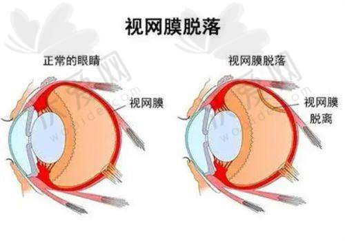 深圳悦瞳眼科儿童蔡司小乐圆离焦镜有什么产品优势？