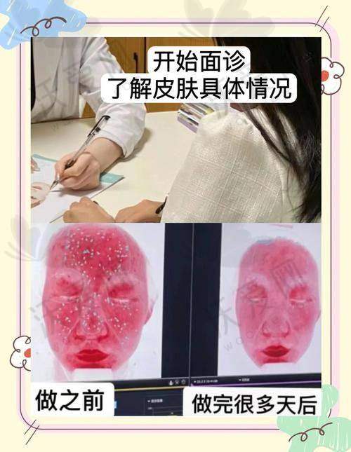安徽合肥维多利亚四代黄金微针技术优势显著
