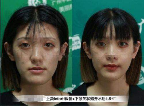 上海伊莱美医疗美容医院李湘原医生技术好不好？