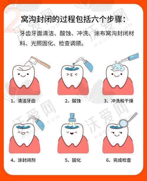 大连洁雅口腔儿童美国3M原装进口窝沟封闭的产品优势
