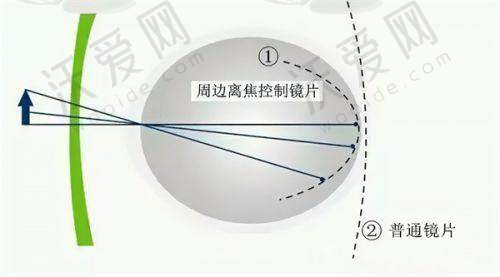 虹膜夹型人工晶体植入术