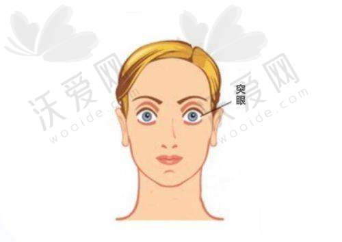 合肥普瑞眼科医院干眼治疗强脉冲光的成效怎么样？