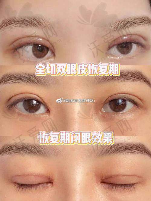 从刘志刚医生个人简介看刘志刚眼修复做的怎么样？技术高超缩短恢复期，自然无痕获患者盛赞