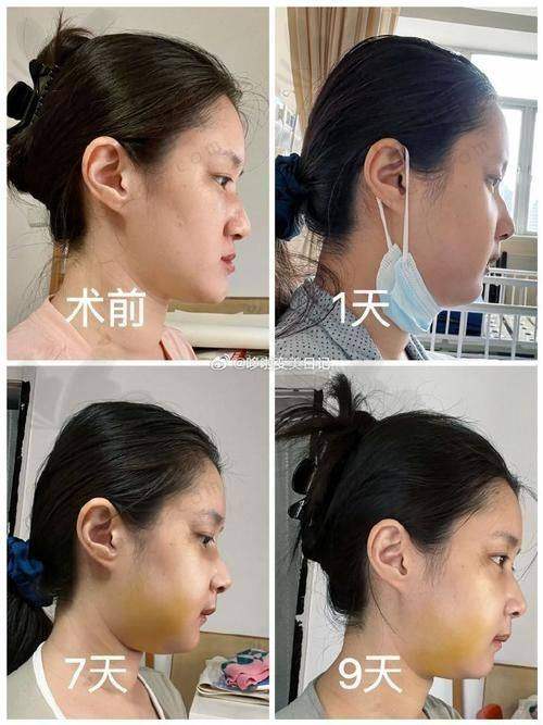 总结——湖南长沙鹏爱医疗美容医院程国玺医生怎么样？