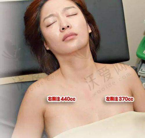 湖南长沙鹏爱医疗美容医院程国玺医生技术好不好？