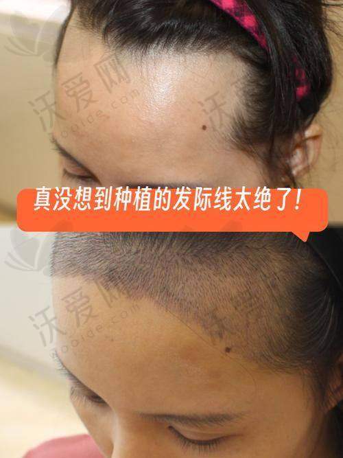 武汉仁爱医院植发科收费价格体系解读