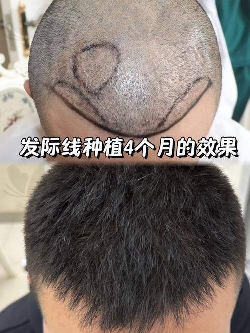 武汉仁爱医院植发科其他植发项目价格参考