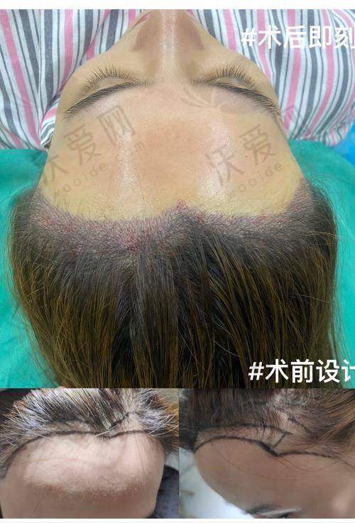 武汉仁爱医院植发科靠谱优势多
