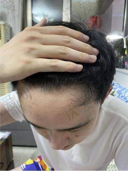武汉仁爱医院植发科种发际线价格实惠