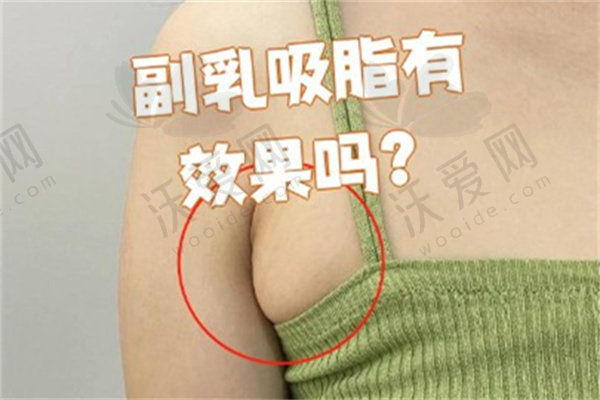广州军美整形医院吸脂去副乳原价9800元起，现6800元起享绿色通道快体验！