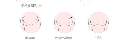 探秘深圳美诗沁港丹医美怎么样？资质专家价格全知晓还有真实腰腹吸脂经历分享