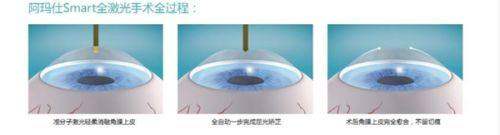 成都青羊阳光爱盾眼科诊所技术好不好？