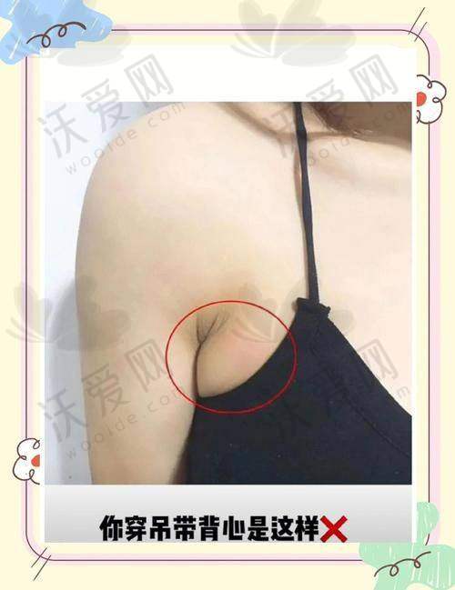广州军美整形医院吸脂去副乳的技术如何？