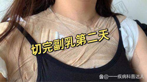 广州军美整形医院吸脂去副乳效果怎么样？