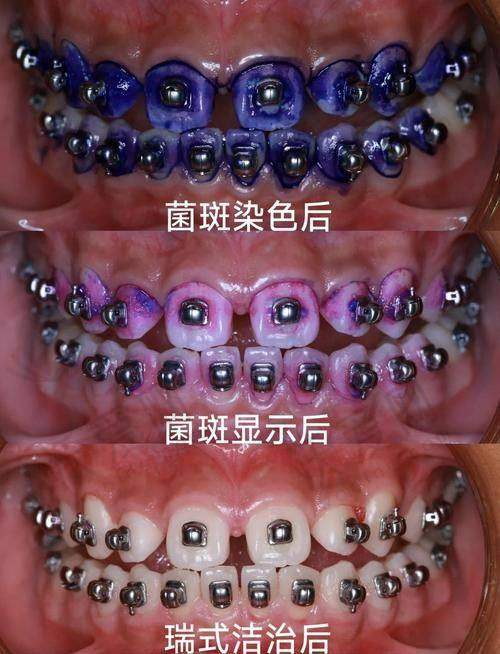 徐州美奥口腔深层喷砂洁牙+护理的作用