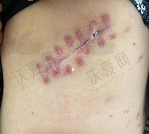 重庆郑荃丽格疤痕修复中 心口碑如何？