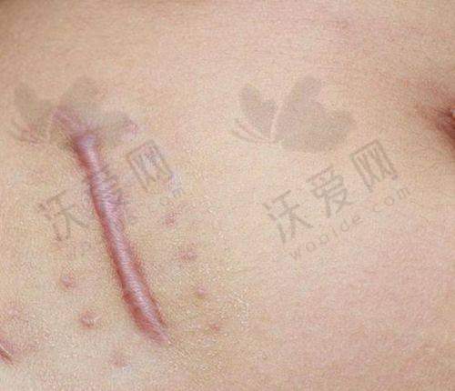 重庆郑荃丽格疤痕修复中 心技术好不好？
