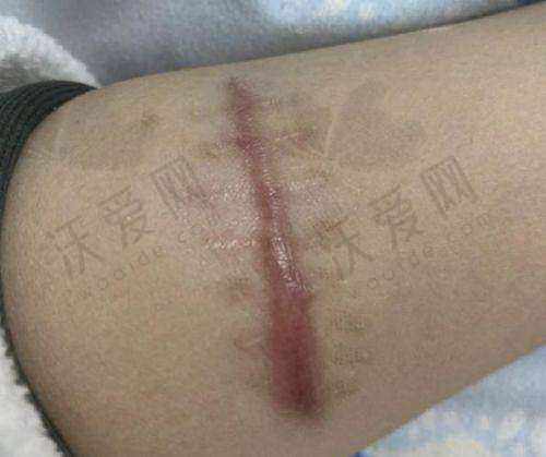 总结评价——重庆郑荃丽格疤痕修复中 心怎么样？